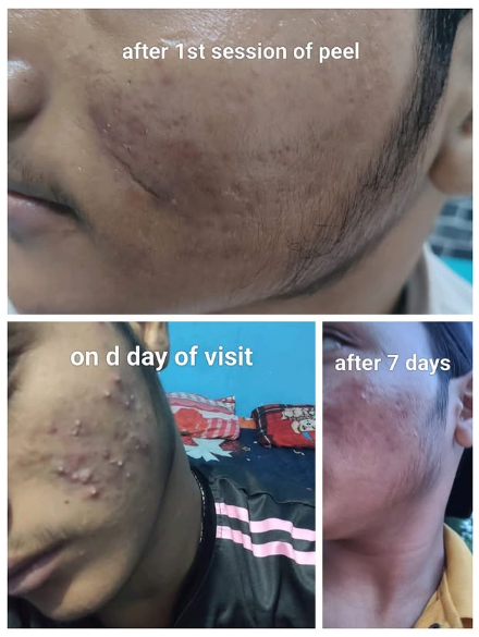 Skin treatment progress collage