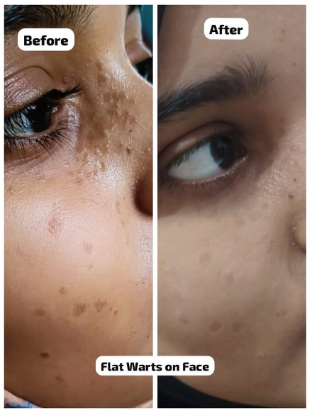 Example of facial skin concern photography