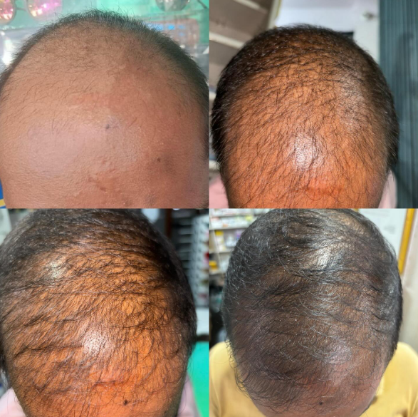 Hair and scalp treatment progress photographs